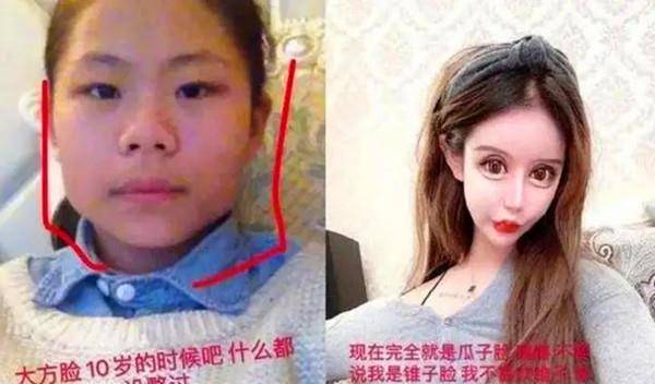 漂亮那个13岁就整容的网红女孩，3年整了60次，如今现状如何？