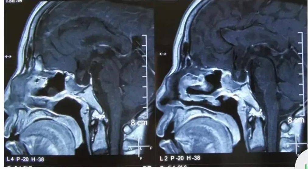 视力|识破“伪装”｜这些症状很可能和垂体腺瘤有关！