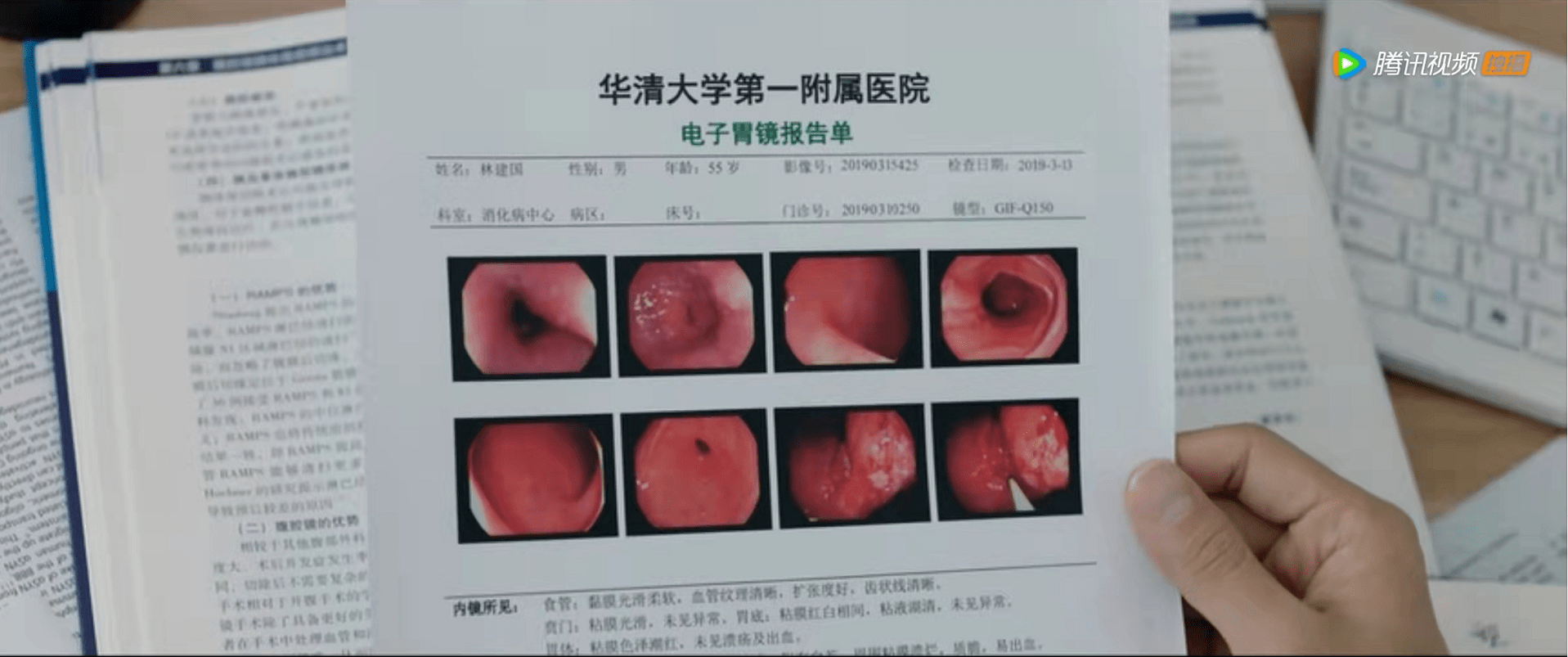 胃镜检查报告单高清图片