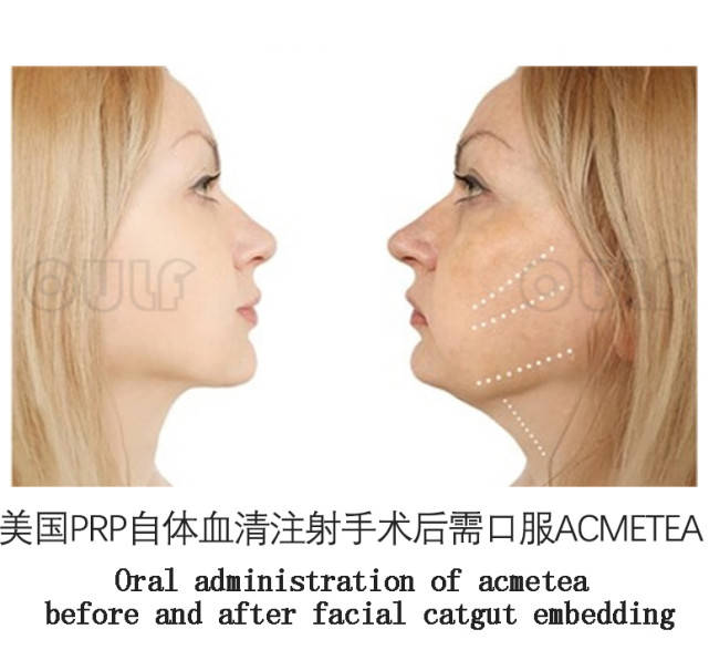 进行埋线多久才能完全恢复自然、做完变身女主的我有话说