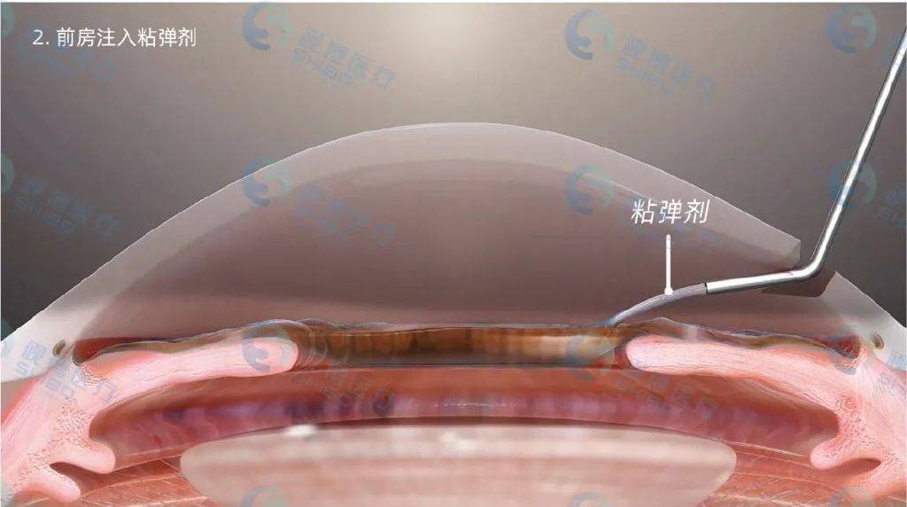 图解内路粘小管成形术abic一种微创高效的青光眼手术