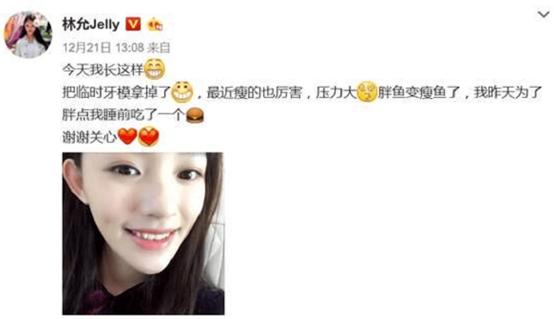 脸部明星整牙后遗症：杨幂脸部松弛，王嘉尔颧骨外扩，宋祖儿法令纹深！！