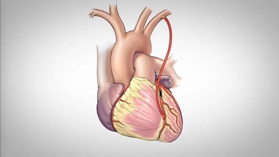 繞過狹窄或堵塞的冠狀動脈位置,建立起一條通路