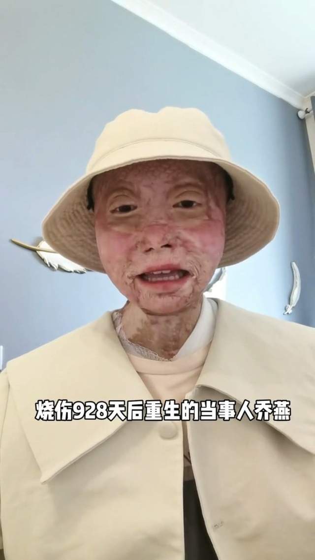 脸部烧伤毁容图片