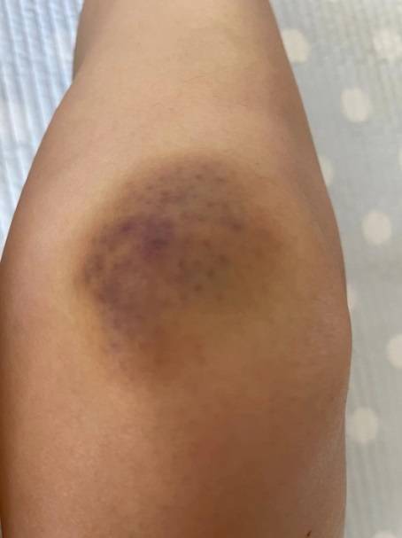 女白领亚朵酒店遭毁容店方出尔反尔协商无果