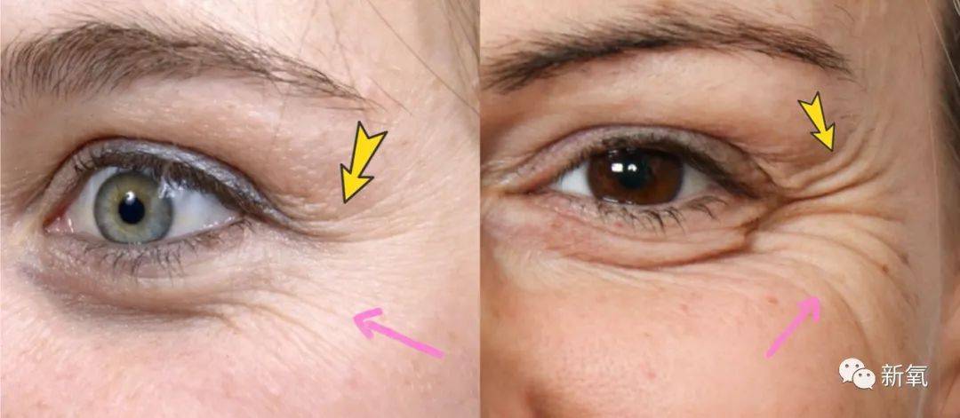久而久之,出现放射鱼尾纹or颧骨之上的"半菊花98皱纹"95要知道哈
