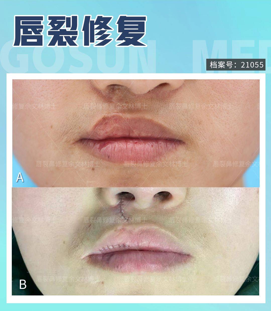 【案例分享】上唇偏薄且无唇珠的患者做了唇裂二期修复手术 - 好大夫在线
