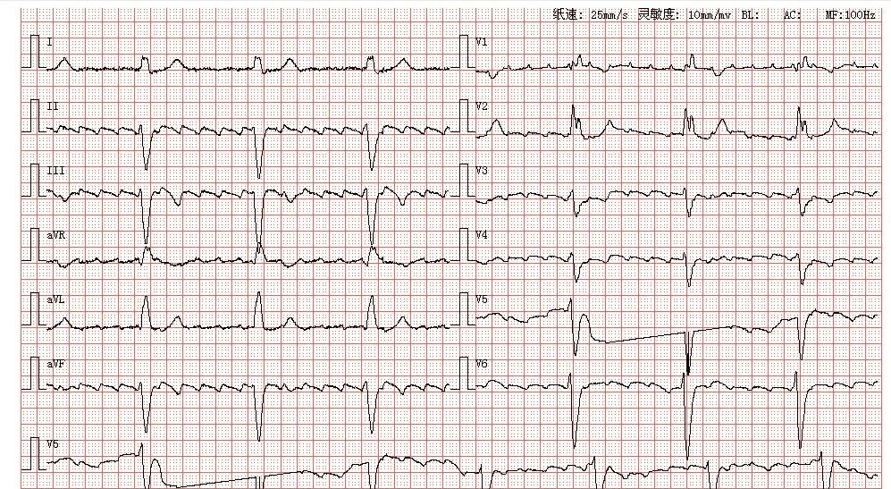 室性扑动心电图图片