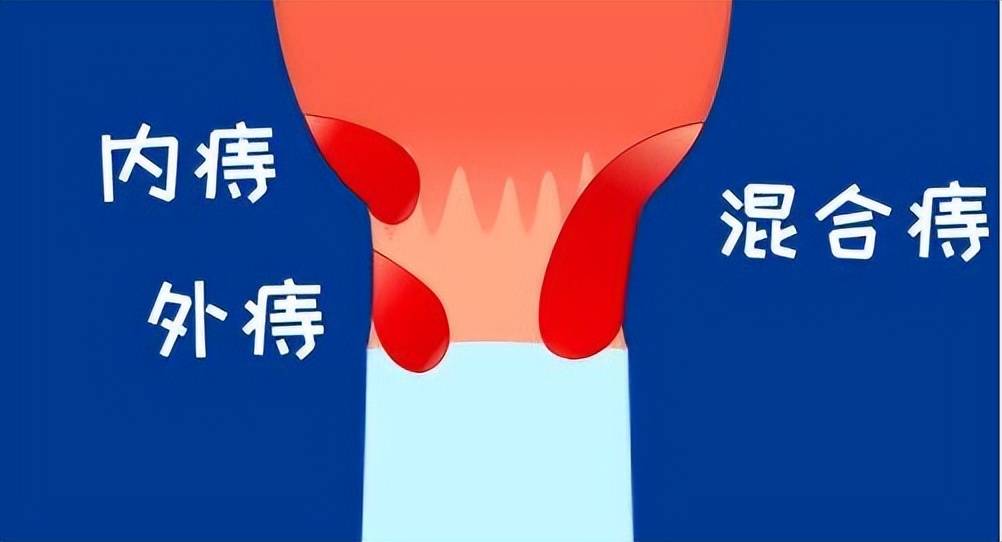 痔疮站不得坐不得面对如此痛苦我该怎么办