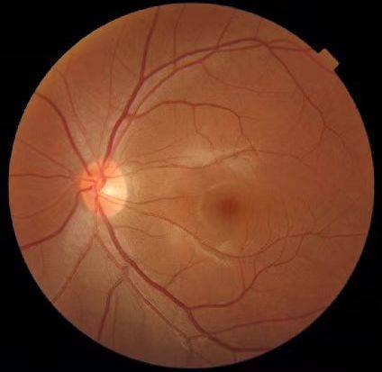 眼底棉绒斑图片图片