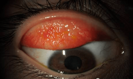 春季角结膜炎是什么得了角结膜炎怎么办