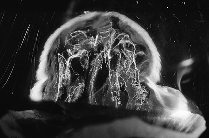 怎么回事!_患者_玻璃体_治疗