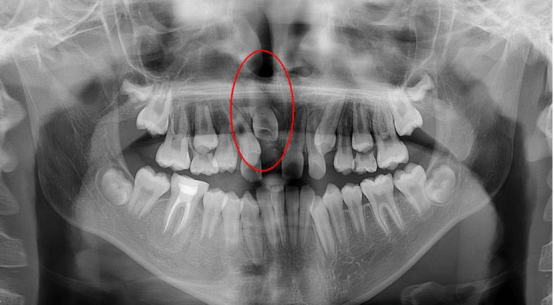 新都華聖藝口腔醫院科普:兒童出現埋伏牙阻生需要拔除嗎?