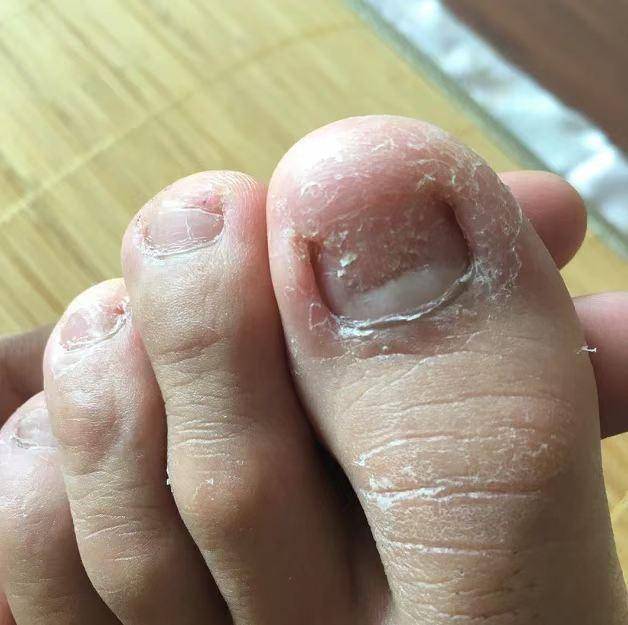 灰指甲拔甲不可取过来人成功经验简单用药治愈不反复