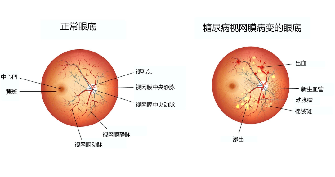 science:干细胞改善2型糖尿病视网膜微血管病变