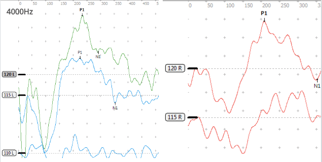 图为a型声导抗鼓室02双侧极重度感音神经性听力损失右耳平均听力>106