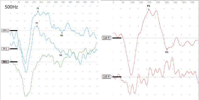 图为a型声导抗鼓室02双侧极重度感音神经性听力损失右耳平均听力>106