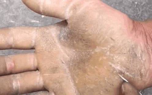 原创男子工地打工多年回家后感觉手痒痒用针挑开后家人不淡定了