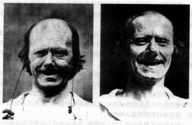 最好的微笑杜兴式微笑