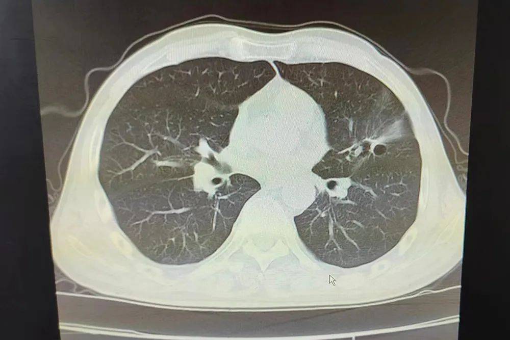 安徽静安医院肿瘤介入科综合治疗可有效延长晚期肺癌患者生存期