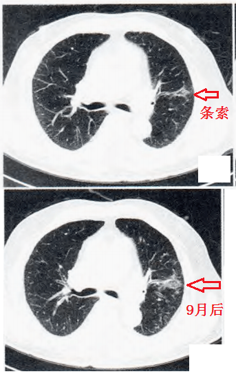 这份肺纤维化肺癌67读片秘籍请收好