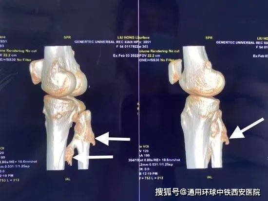 小腿麻木足背難抬起有類似症狀當心骨軟骨瘤