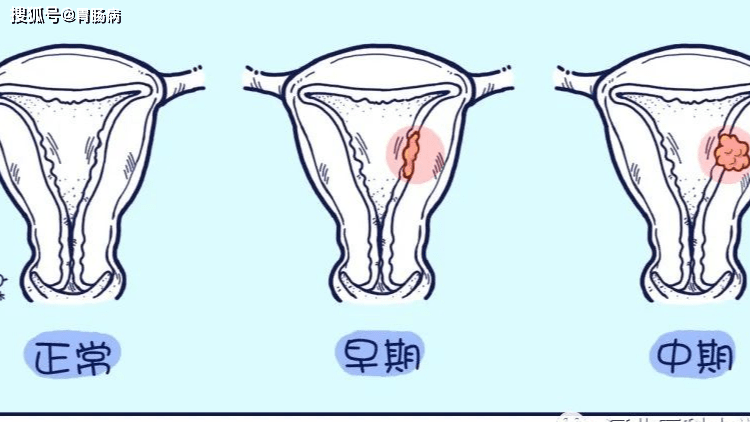 58岁大妈,突然又来了“大姨妈”,以为是“返老还童”;一查,坏了…