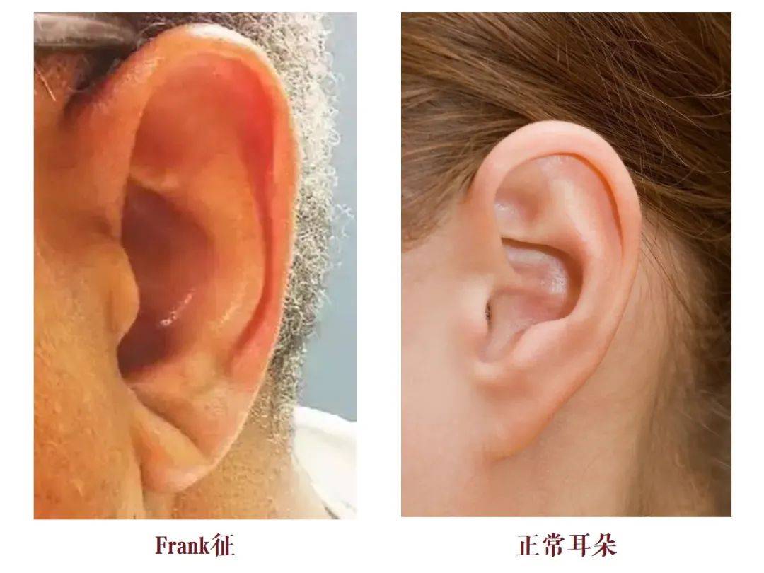 什么是frank征呢?我给大家看张图就知道了.1973年,一位叫sanders t.