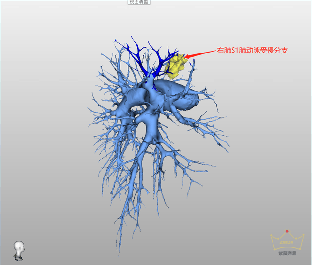 右肺支气管三维图图片