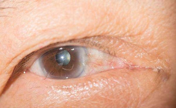 原创视网膜病变是糖尿病并发症之一眼睛出现5种情况需重视