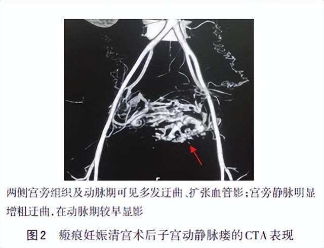 早期妊娠相关子宫动静脉瘘诊治的中国专家共识2022年版