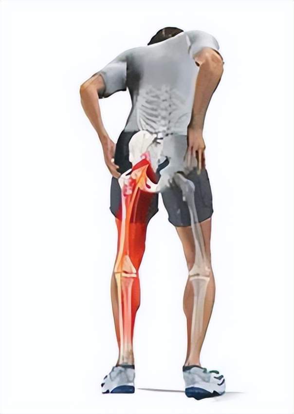 臀部痛腿痛麻木和脚痛是根性坐骨神经痛还是干性看这几类病