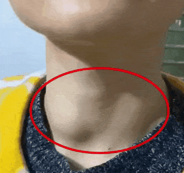 甲状腺正常的脖子形状图片