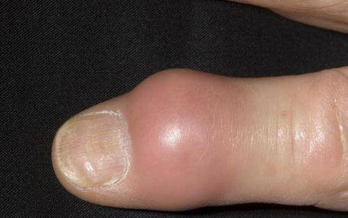 大多数痛风,发生在夜间,首部位,常是大脚趾,关节红肿,灼热发胀,几天或