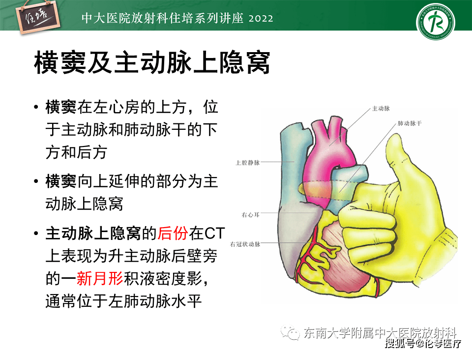 心包隐窝解剖图片