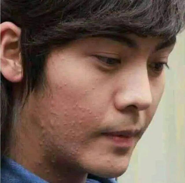 无论是三石弟弟还是陈伟霆这样的型男,小鲜肉都是深受着痘痘的困扰,陈