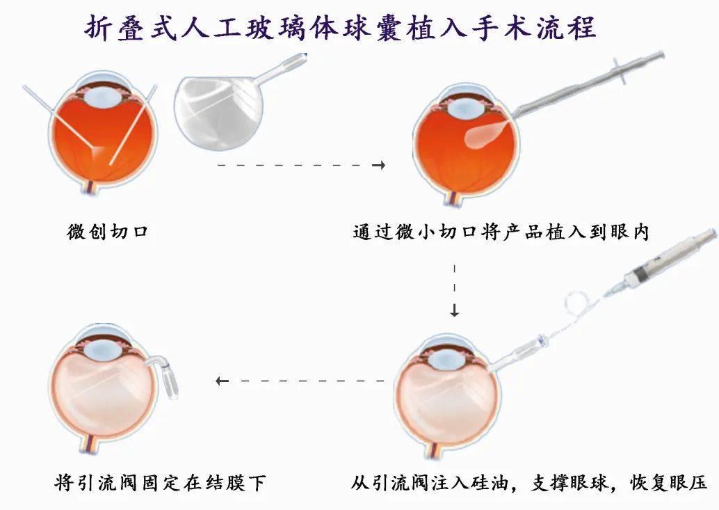 男子眼外伤导致硅油依赖眼面临眼摘，医院用新技术为他保眼球