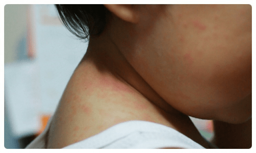 因为我做对了这件事!_栗子_过敏原_净化