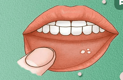 抽烟竟然对口腔有这么大的危害?_牙齿_白斑_牙龈