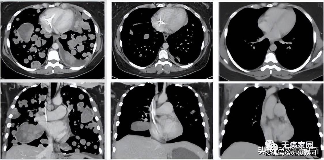 肺癌晚期,全身多处转移,与癌共存7年甚至16年,多款靶向药带来更多惊喜