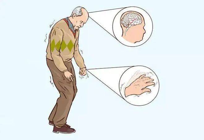 巴金森氏症怎么治?1碗蒸蛋补肾活脑 抗退化 | 帕金森氏症 | 中医 | 药膳 | 大纪元