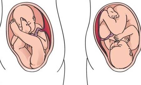 【胎儿臀位】胎儿臀位的危害_胎儿臀位如何纠正