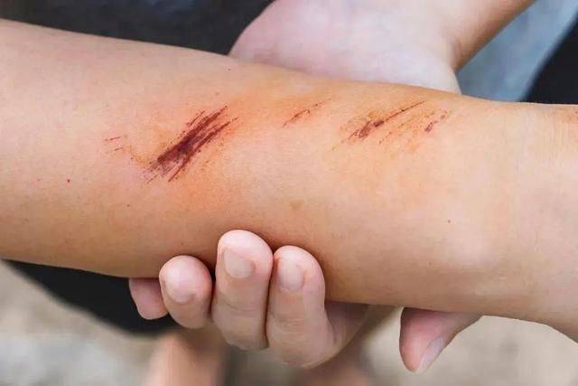 原创磕伤刺伤切伤伤伤伤正确的处理方法一文捋清
