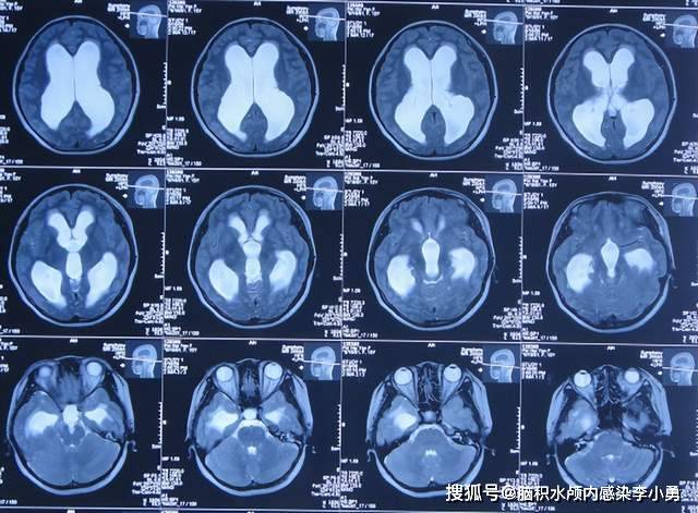 腦積水術後14年內反覆堵管腦室內被放3根分流管反覆現視物模糊頭暈