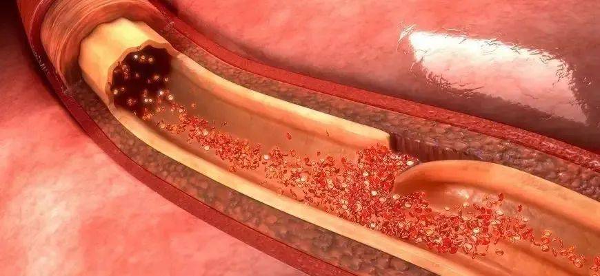 【健康科普】主动脉夹层--危险的"不定时炸弹"!_患者_血压_造影