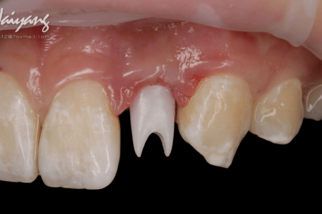 正畸牵引联合氧化锆基台修复双侧侧切牙缺失1例爱迪特跨学科临床病例