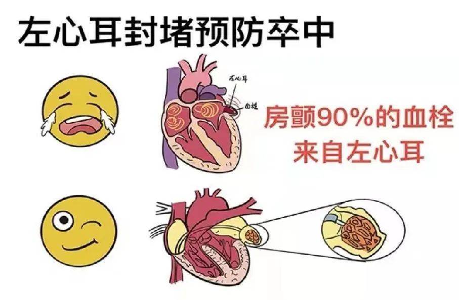 关注房颤预防卒中宝鸡第三医院房颤科普在行动