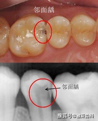 牙齿釉面横纹图片图片