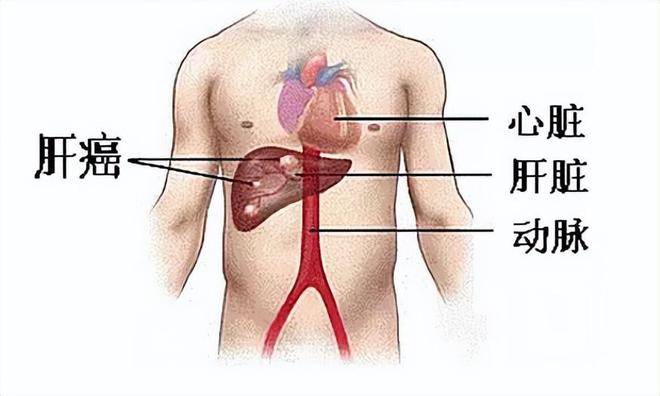 佳佳被诊断为原发性肝癌.