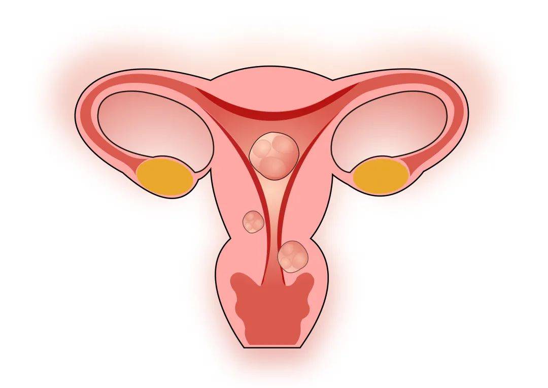 【子宫肌瘤】子宫肌瘤的症状_子宫肌瘤不能吃什么
